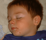 safe laser bőrprobléma