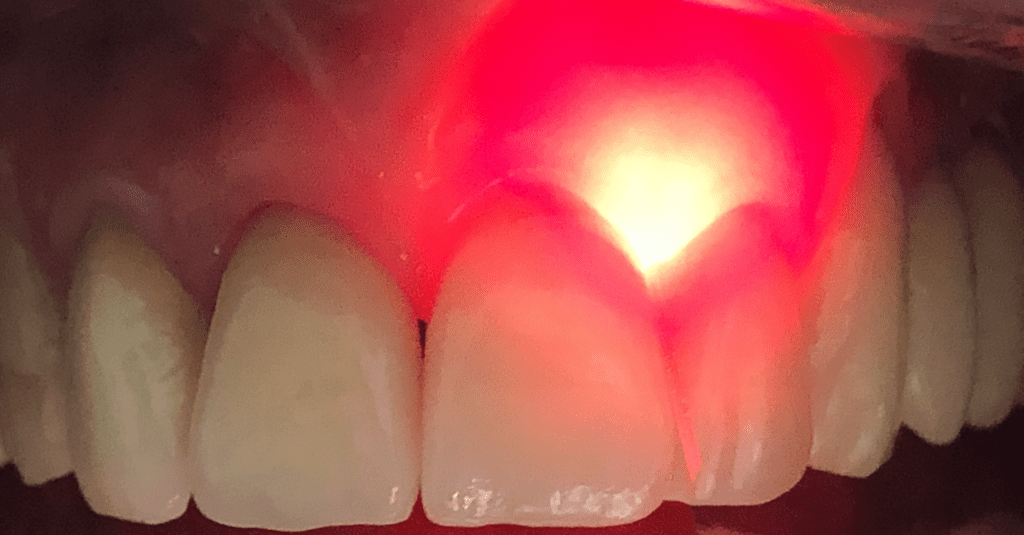 lágylézer kezelés