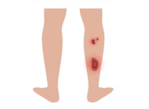 diabetes végtagfekély